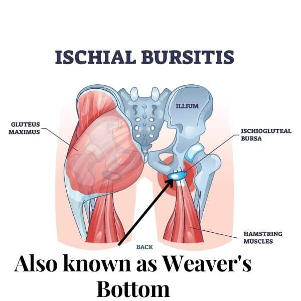 Ischial Bursitis: also known as Weaver's Bottom caused by prolonged pressure on sit bones.